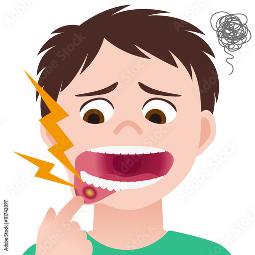 stomatitis, mouth ulcer, inflammation of the oral mucosa, image illustration