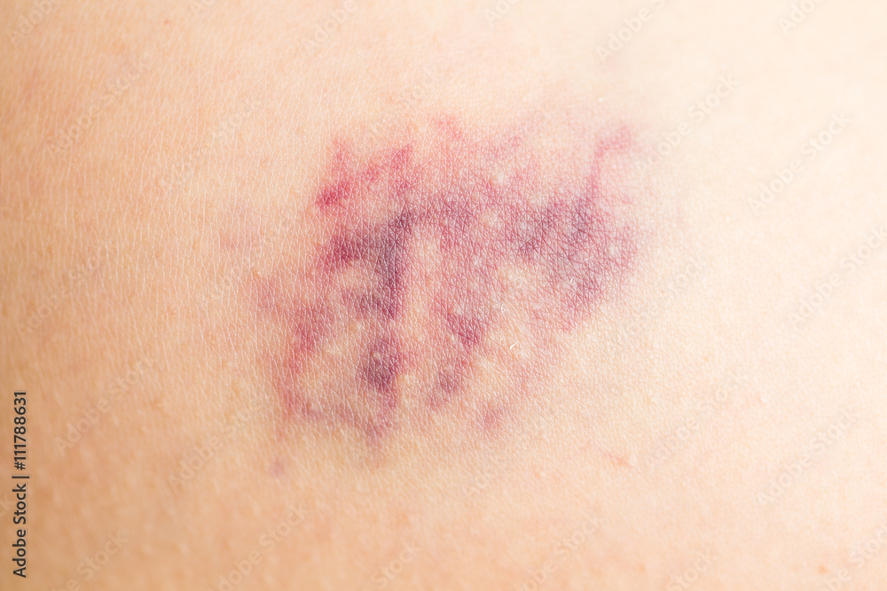  Bruise on wounded woman leg skin