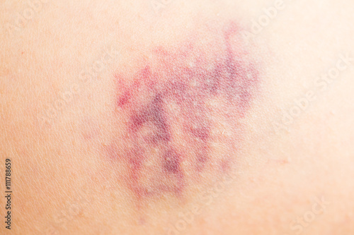Bruise on wounded woman skin