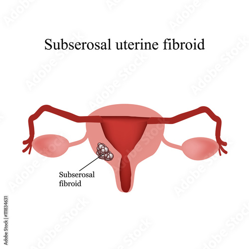 Subserous uterine fibroids. Endometriosis. Infographics. Vector illustration on isolated background