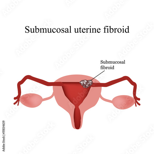 Submucosal fibroids. Endometriosis. Infographics. Vector illustration on isolated background