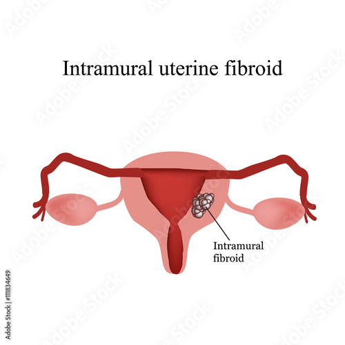 Intramural uterine fibroids. Endometriosis. Infographics. Vector illustration isolated on white background photo