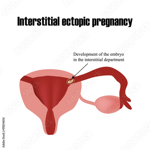 Development of the embryo in the interstitial department. Ectopic pregnancy. Infographics. Vector illustration