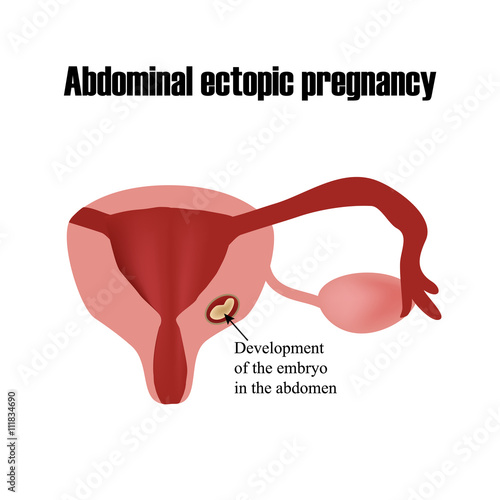 Development of the embryo in the abdomen. Ectopic pregnancy. Infographics. Vector illustration on isolated background