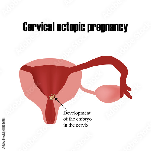 Development of the embryo in the cervix. Ectopic pregnancy. Infographics. Vector illustration on isolated background photo