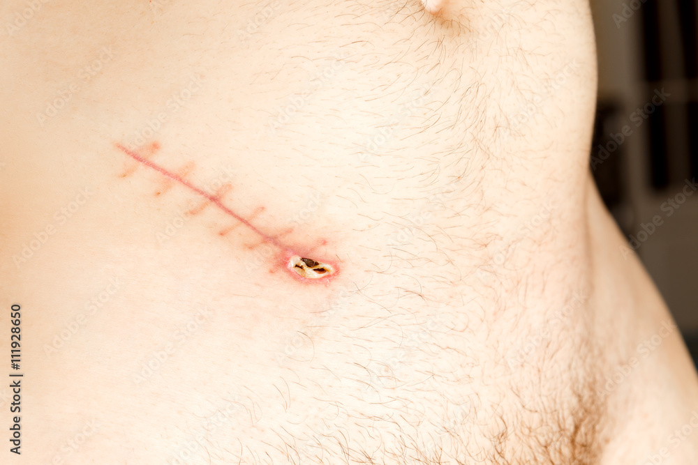 Fototapeta premium Closeup of unhealed appendix surgery scar