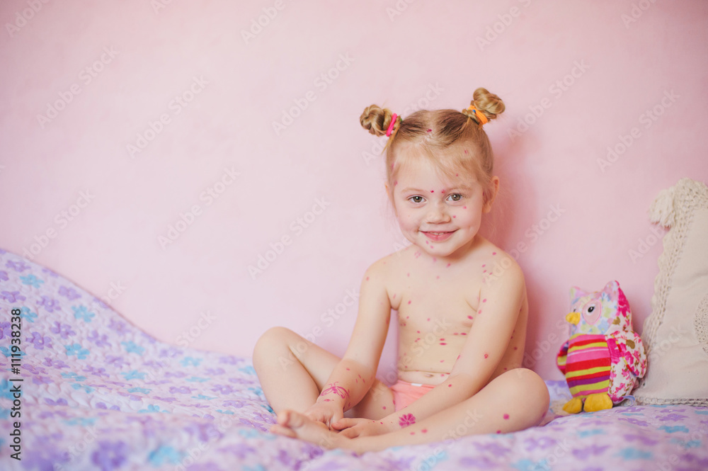 baby sitting on bed with chicken pox rash, natural photo baby sitting on bed with chicken pox rash, natural photo