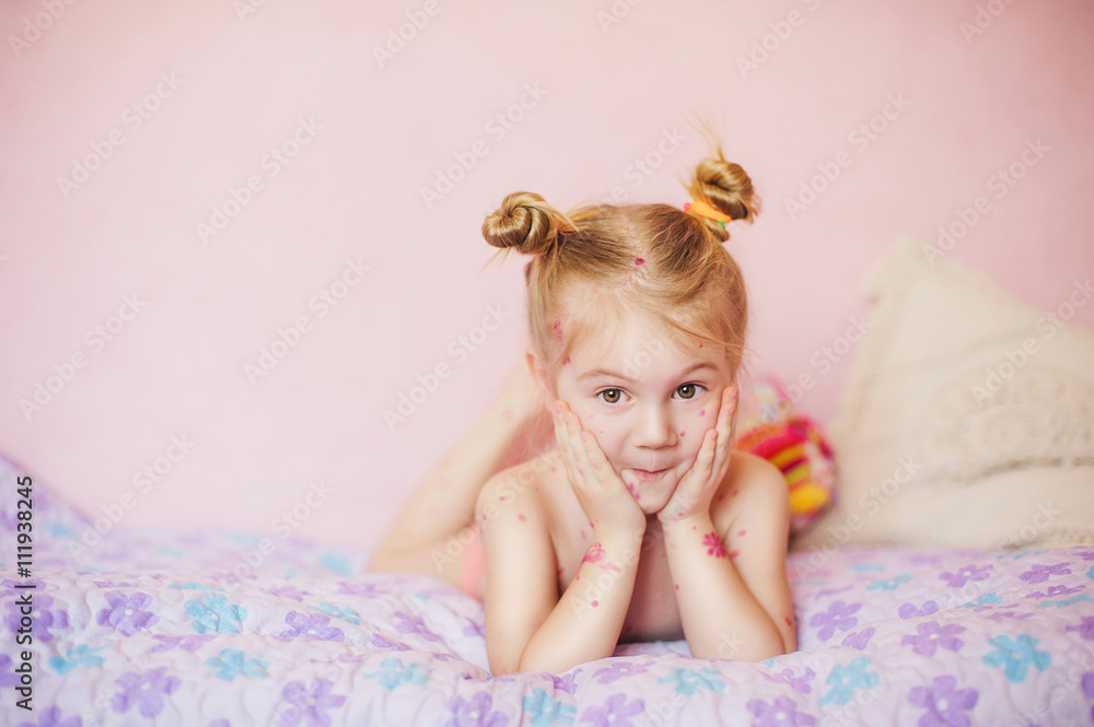 baby on bed with chicken pox rash baby on bed with chicken pox rash