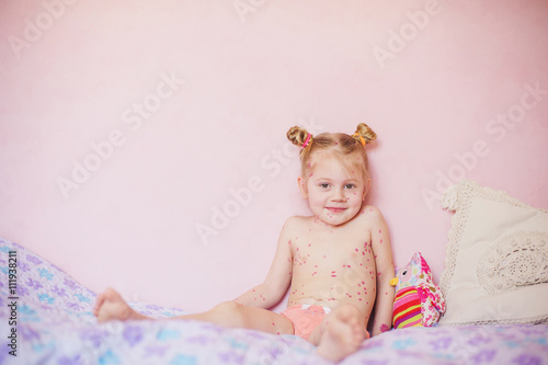 Fotografie baby sitting on bed with  chicken pox rash, natural photo