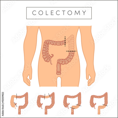 Types of colectomy photo