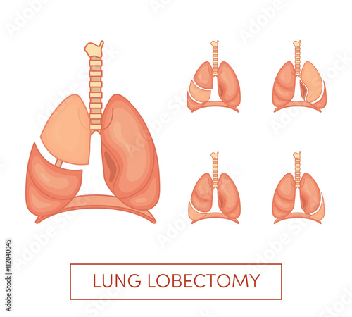 Lung lobectomy vector