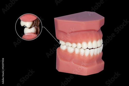 gnashing of teeth dental molars callout
