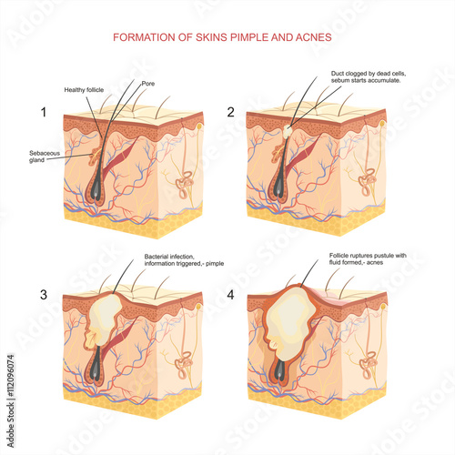 pimple and acnes