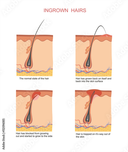 Ingrown hairs