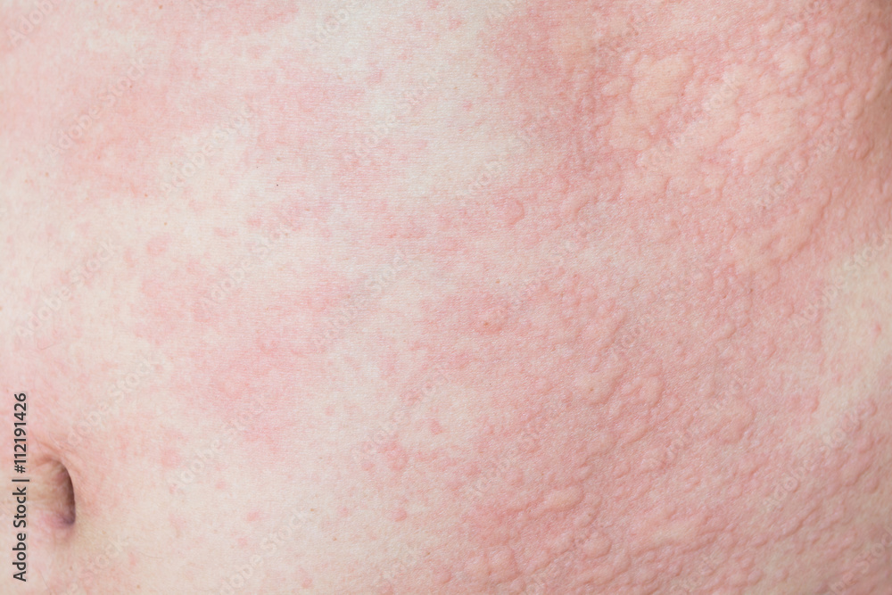 rashes in skin