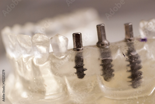 Primo piano di un impianto dentale