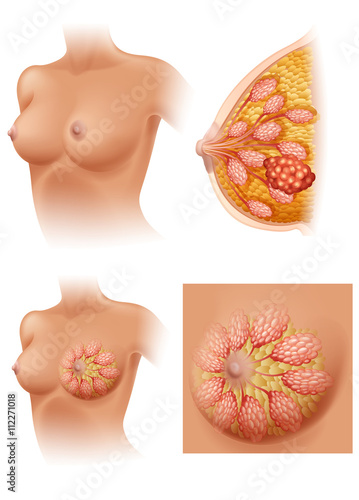 Diagram of woman having breast cancer