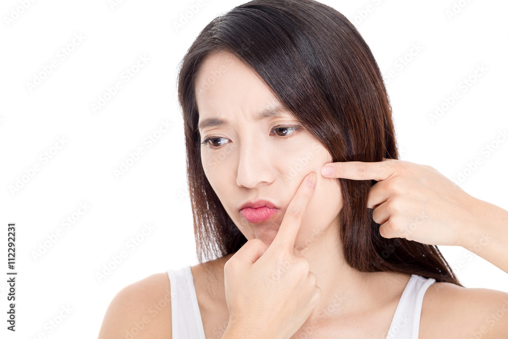 Asian woman with Acne spot pimple problem Asian woman with Acne spot pimple problem