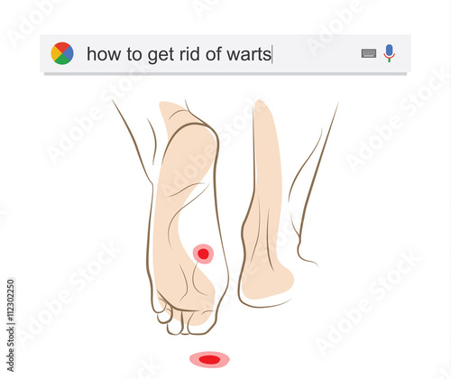 Searching the web for information about getting rid of warts vector