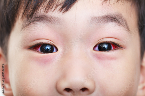 Closeup of chronic conjunctivitis with a red iris.