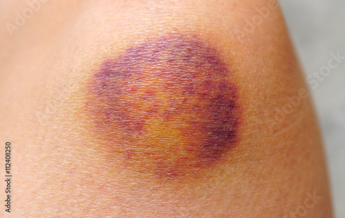 Bruise on wounded woman leg skin