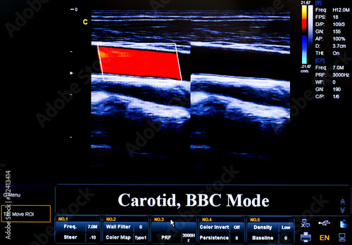 Colourful ultrasound monitor image. Carotid artery photo