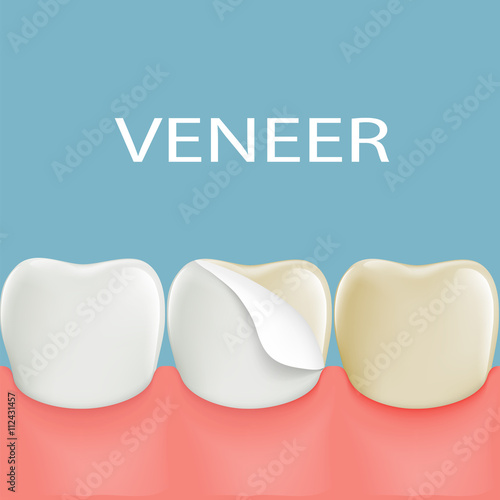 Dental veneers on a human tooth. Stock vector