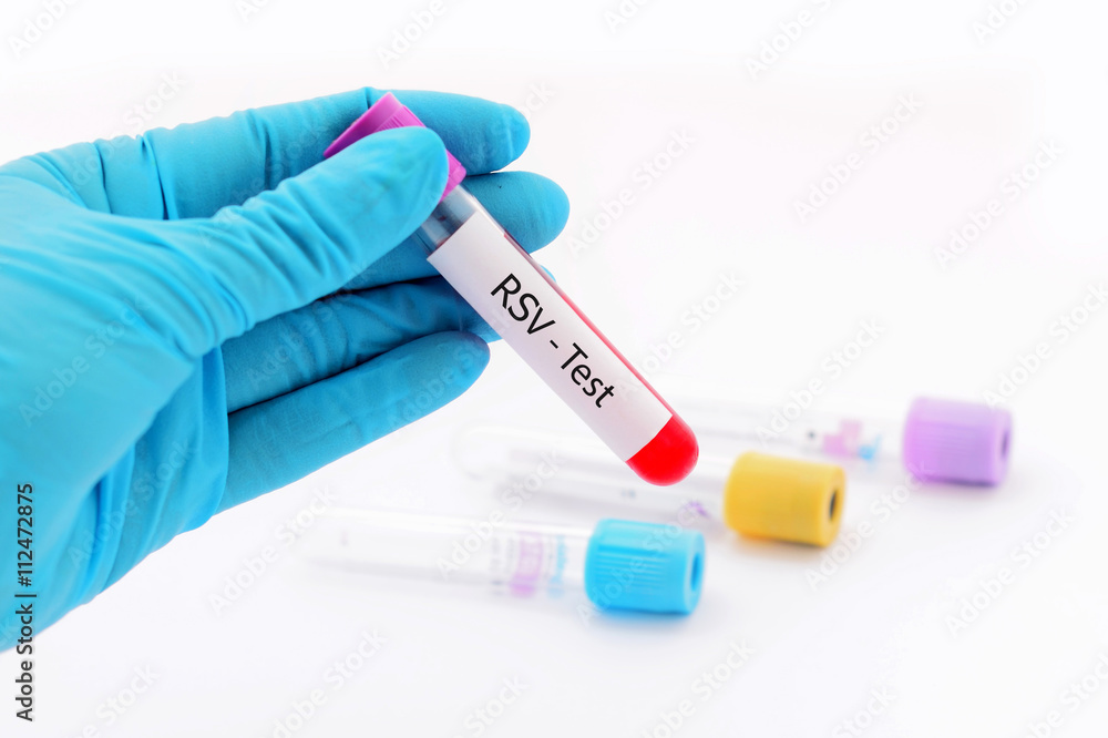 Respiratory syncytial virus (RSV) test Respiratory syncytial virus (RSV) test