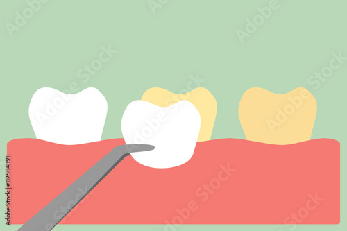 veneers teeth