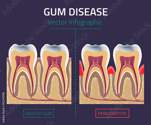 Gum disease vector