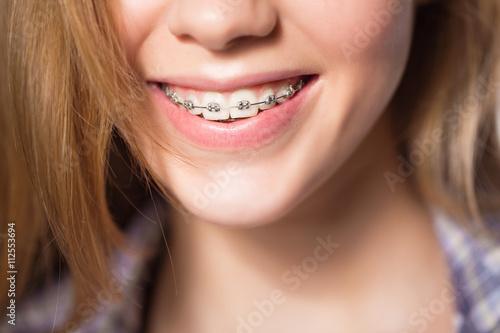 Portrait of teen girl showing dental braces.