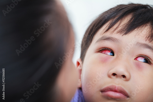 Closeup of chronic conjunctivitis with a red iris. photo