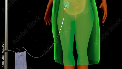 Peritoneal dialysis