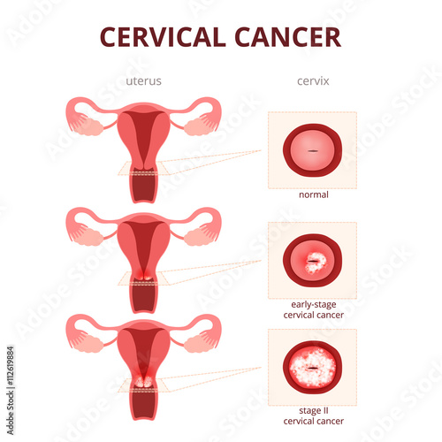 cervical cancer schematic illustration photo