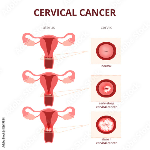 cervical cancer schematic illustration