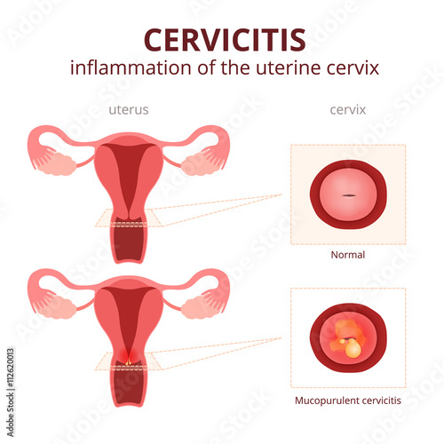 cervicitis schematic illustration photo