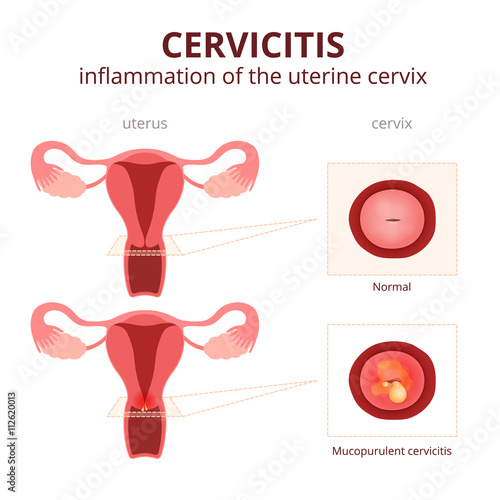 cervicitis schematic illustration