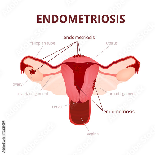 Endometriosis in the uterus