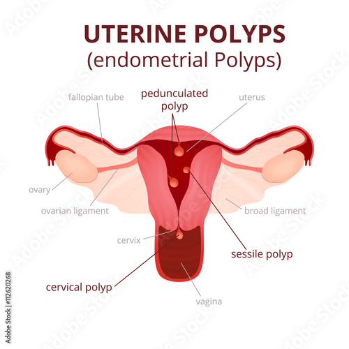 classification of uterine polyps