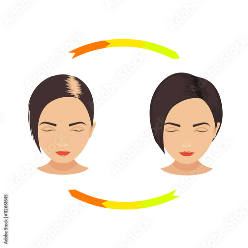 Woman with thinning hair before and after hair treatment and hair transplantation. Female pattern hair loss set. Hair care concept. Isolated vector illustration.