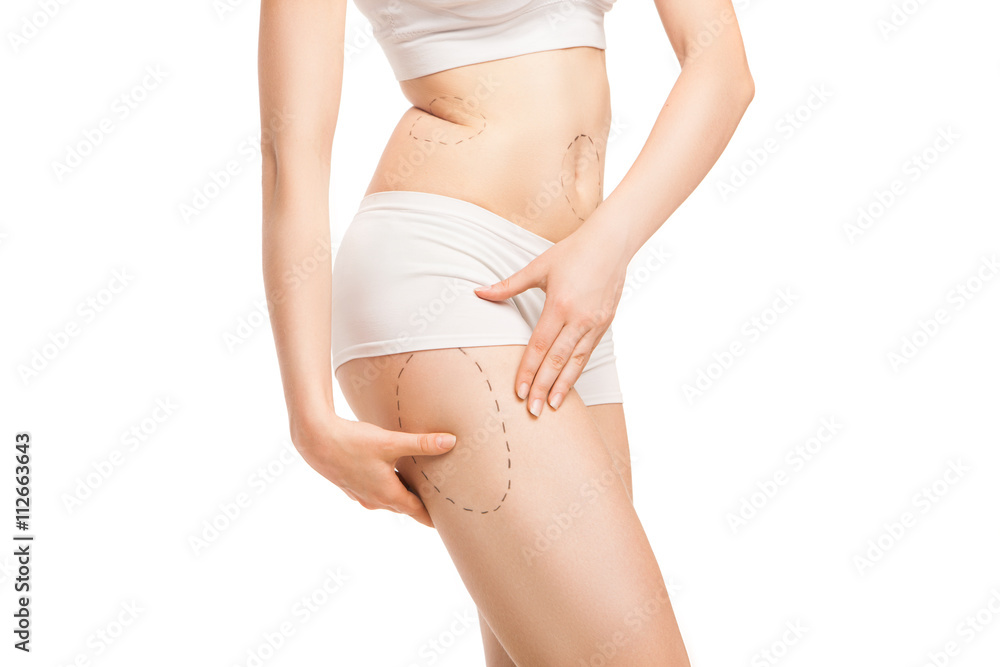 Woman with outlines for plastic surgery on body Woman with outlines for plastic surgery on body