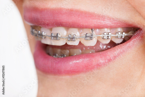 Photography woman with teeth braces