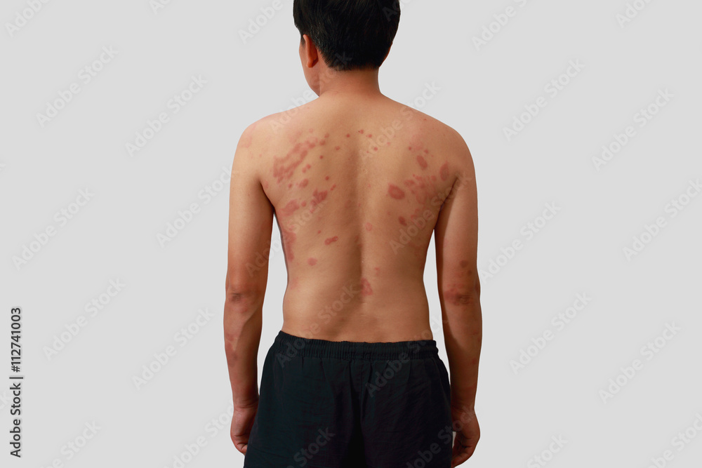 Fototapeta premium Around Back view of man with dermatitis problem of rash ,Allergy rash