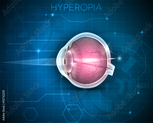  Hyperopia, vision disorder on a blue technology background. Hyperopia is being long sighted (far sighted). Near object seems blurry. 