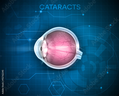 Cataracts. Human vision disorder, detailed anatomy of cataracts and healthy eye.