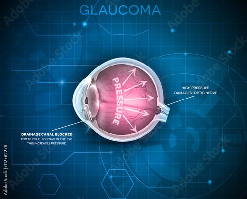 Glaucoma, vision disorder. Detailed anatomy of Glaucoma, eye disorder on a blue technology background.