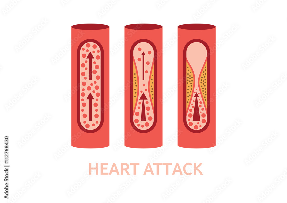 heart attack symptoms vector heart attack symptoms vector