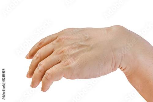 Photos Ganglion cyst