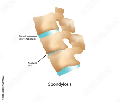 Spondylosis