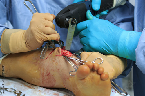 Surgeons saw the bone setting the Ilizarov apparatus during the orthopedic surgery